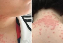 عائلة أميركية تقاضي طيران بسبب بقّ الفراش عائلة أميركية تقاضي طيران بسبب بقّ الفراش