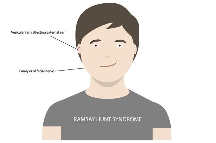 What is Ramsay Hunt syndrome, the virus causing Justin Bieber’s facial paralysis?