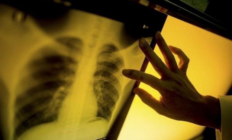 المغرب: تسجيل 29 ألفا و18 حالة إصبة بداء السل خلال 2020