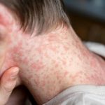 تفشي بوحمرون في هولندا مرتبط برحلة إلى المغرب تفشي بوحمرون في هولندا مرتبط برحلة إلى المغرب