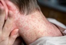 تفشي بوحمرون في هولندا مرتبط برحلة إلى المغرب تفشي بوحمرون في هولندا مرتبط برحلة إلى المغرب