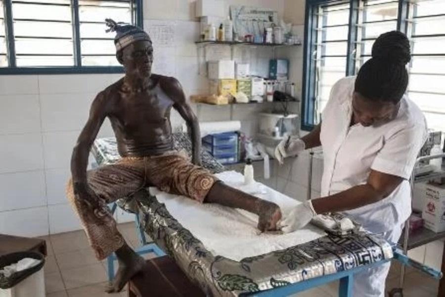 Cabo Delgado records 568 new cases of leprosy Cabo Delgado records 568 new cases of leprosy