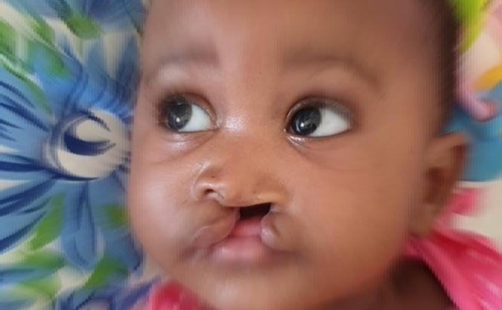 Cleft Lip: A Serious Health Problem in Mozambique Cleft Lip: A Serious Health Problem in Mozambique
