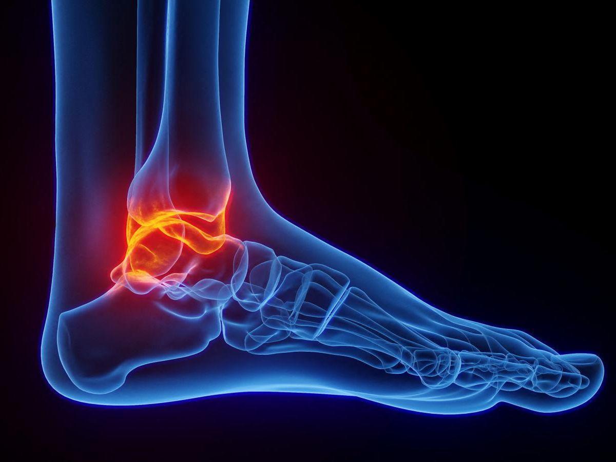 Un outil mathématique pour prévoir les risques de rhumatismes psoriasiques Un outil mathématique pour prévoir les risques de rhumatismes psoriasiques