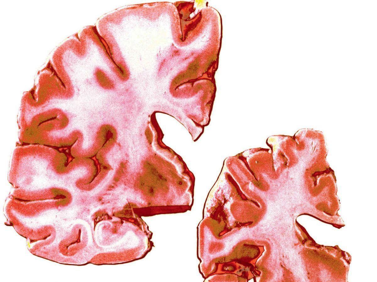 Alzheimer : les médicaments de l'espoir Alzheimer : les médicaments de l'espoir