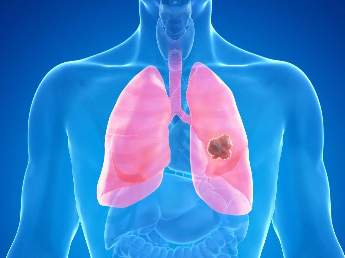 Cancer du poumon : un vaccin français permet de gagner plusieurs mois de survie Cancer du poumon : un vaccin français permet de gagner plusieurs mois de survie