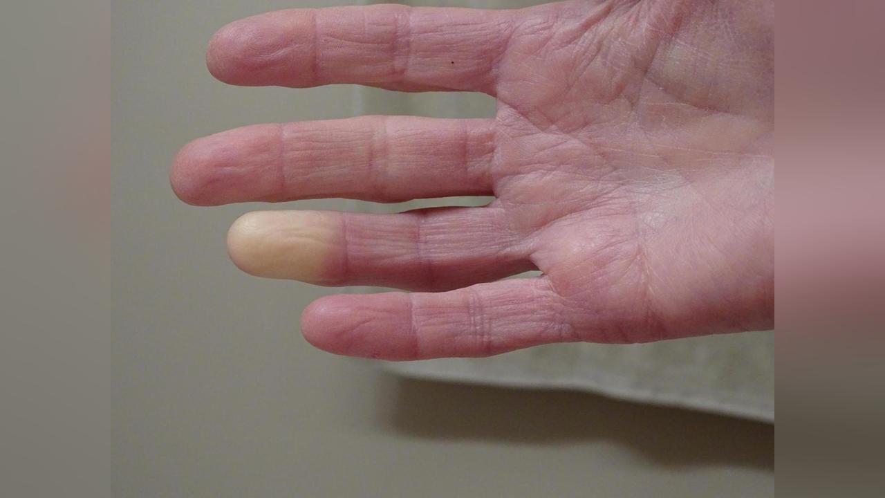 Maladie de Raynaud : découverte de deux gènes impliqués dans cette pathologie douloureuse Maladie de Raynaud : découverte de deux gènes impliqués dans cette pathologie douloureuse