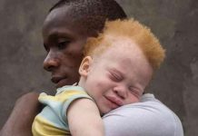 Albinism Stigma Myths and Ritualistic Fears Albinism Stigma Myths and Ritualistic Fears