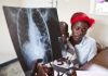 Tuberculosis Deaths Linked to Late Detection Tuberculosis Deaths Linked to Late Detection