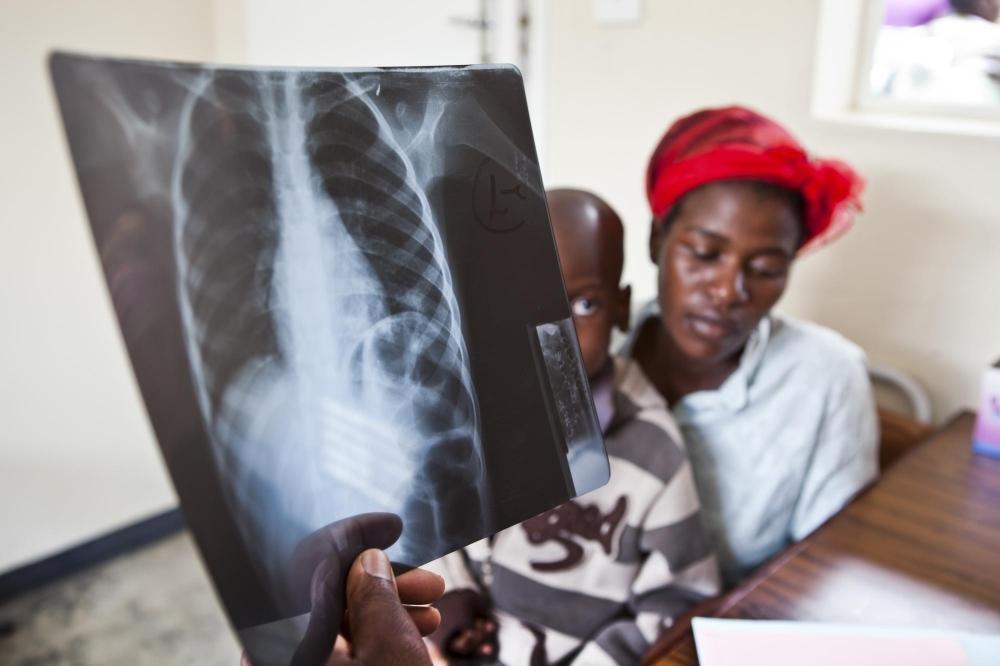 Tuberculosis Deaths Linked to Late Detection Tuberculosis Deaths Linked to Late Detection