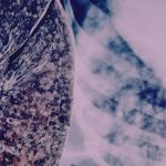 “وفاة مليون شخص بسبب أخطر مرض معدي عالمي” "وفاة مليون شخص بسبب أخطر مرض معدي عالمي"