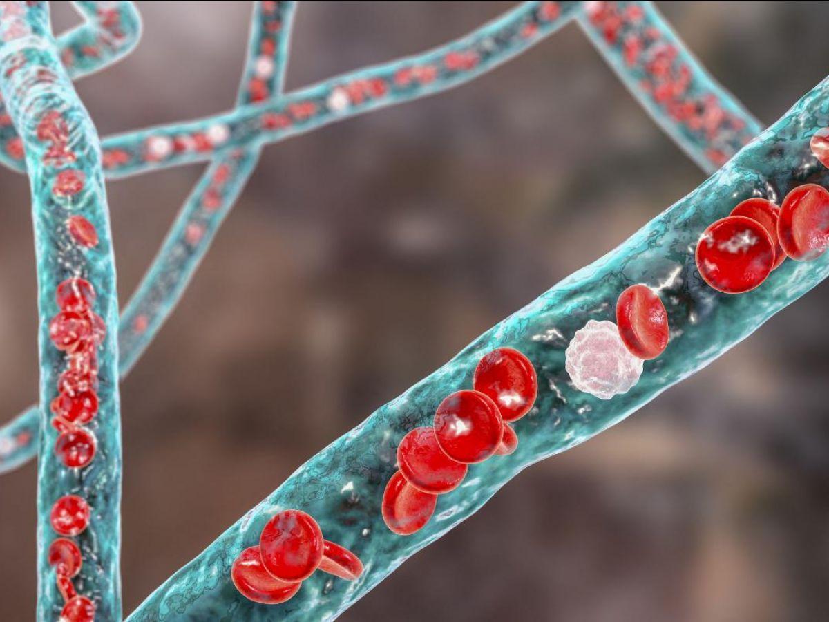 Détruire les caillots sanguins par vortex d’ultrasons Détruire les caillots sanguins par vortex d’ultrasons
