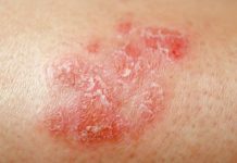 Le Psoriasis: Définition, SymptôMes, Traitement Le Psoriasis: Définition, SymptôMes, Traitement