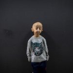 Gène de Centenaires Contre la Progéria Rarissime Gène de Centenaires Contre la Progéria Rarissime