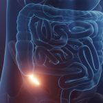 Efficacité des Antibiotiques pour Traiter L’Appendicite Efficacité des Antibiotiques pour Traiter L’Appendicite