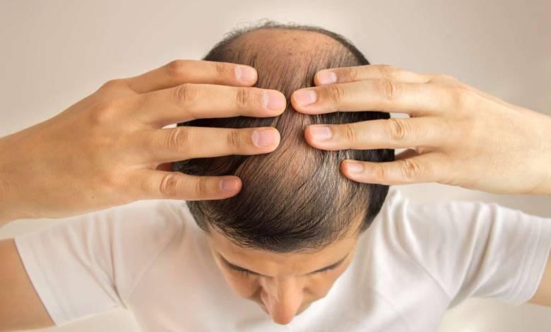 Thaïlande : des scientifiques affirment avoir découvert un remède pour lutter contre la perte des cheveux ! Thaïlande : des scientifiques affirment avoir découvert un remède pour lutter contre la perte des cheveux !