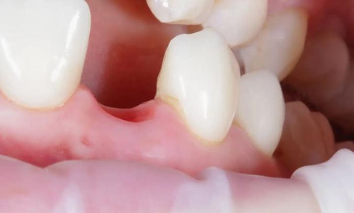 Un médicament qui fait repousser les dents bientôt en essai clinique Un médicament qui fait repousser les dents bientôt en essai clinique