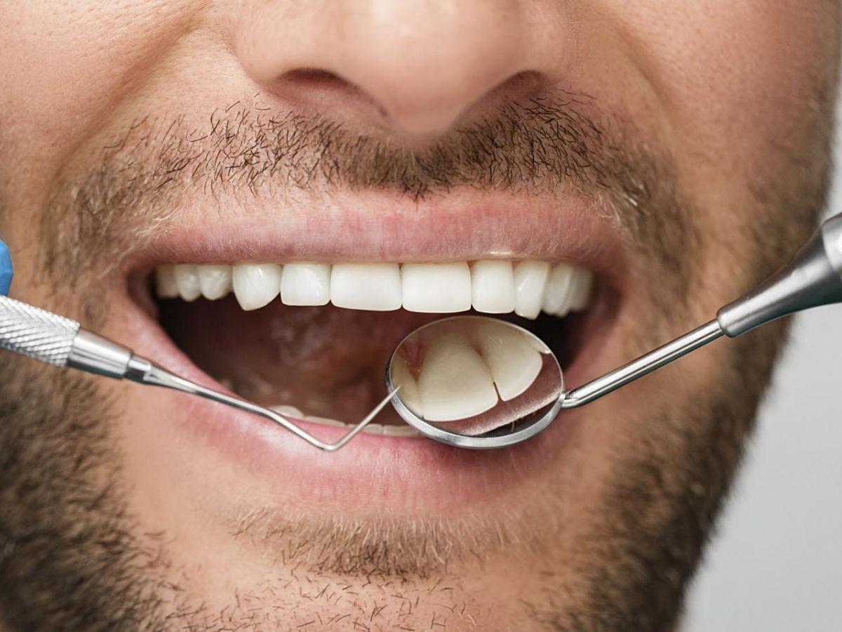 Bridges dentaires : comment préserver les dents saines ?