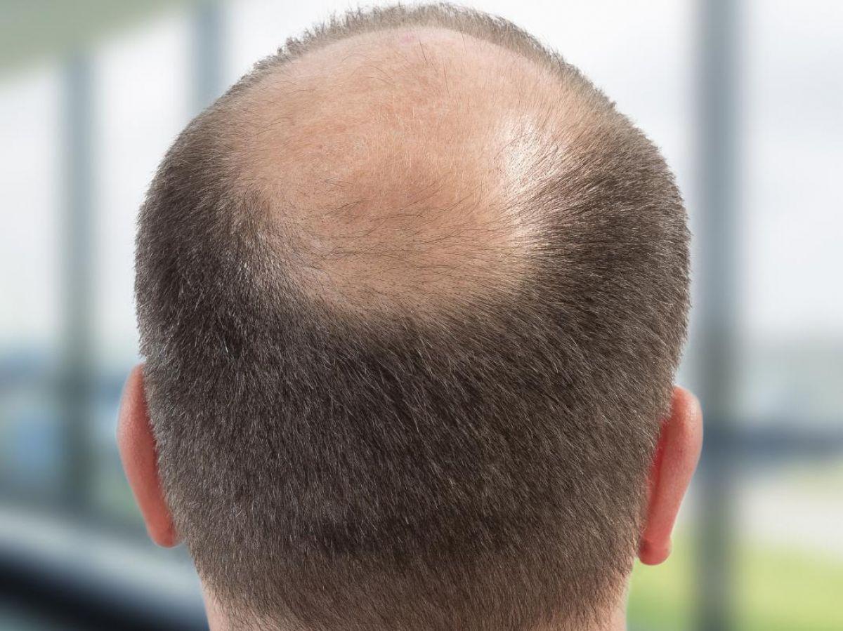 Du sucre pour faire repousser les poils.. et les cheveux ? Du sucre pour faire repousser les poils.. et les cheveux ?
