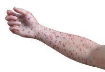 Virus de Marburg: L’épidémie au Rwanda Est Terminée Virus de Marburg: L'épidémie au Rwanda Est Terminée