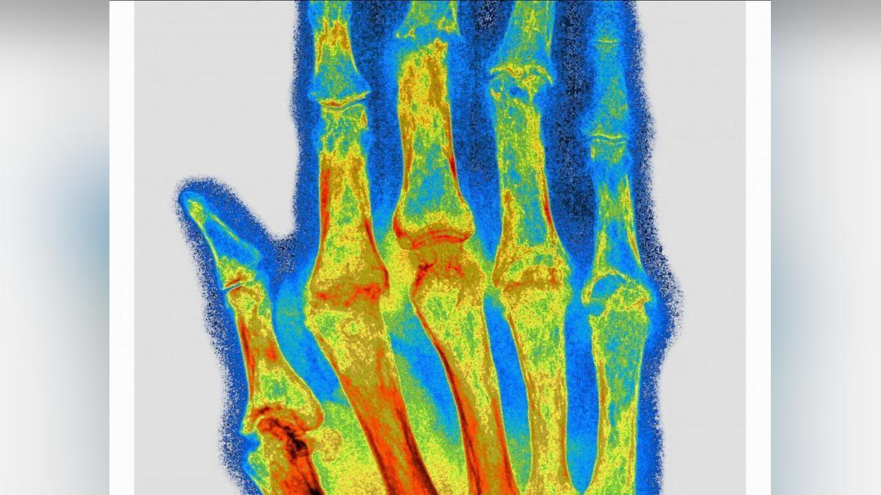Vers un Implant pour Soigner la Polyarthrite RhumatoïDe? Vers un Implant pour Soigner la Polyarthrite RhumatoïDe?
