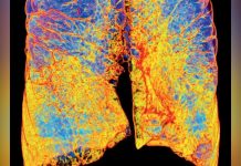 Poumons: BPCO, L’épidémie Silencieuse Poumons: BPCO, L’épidémie Silencieuse