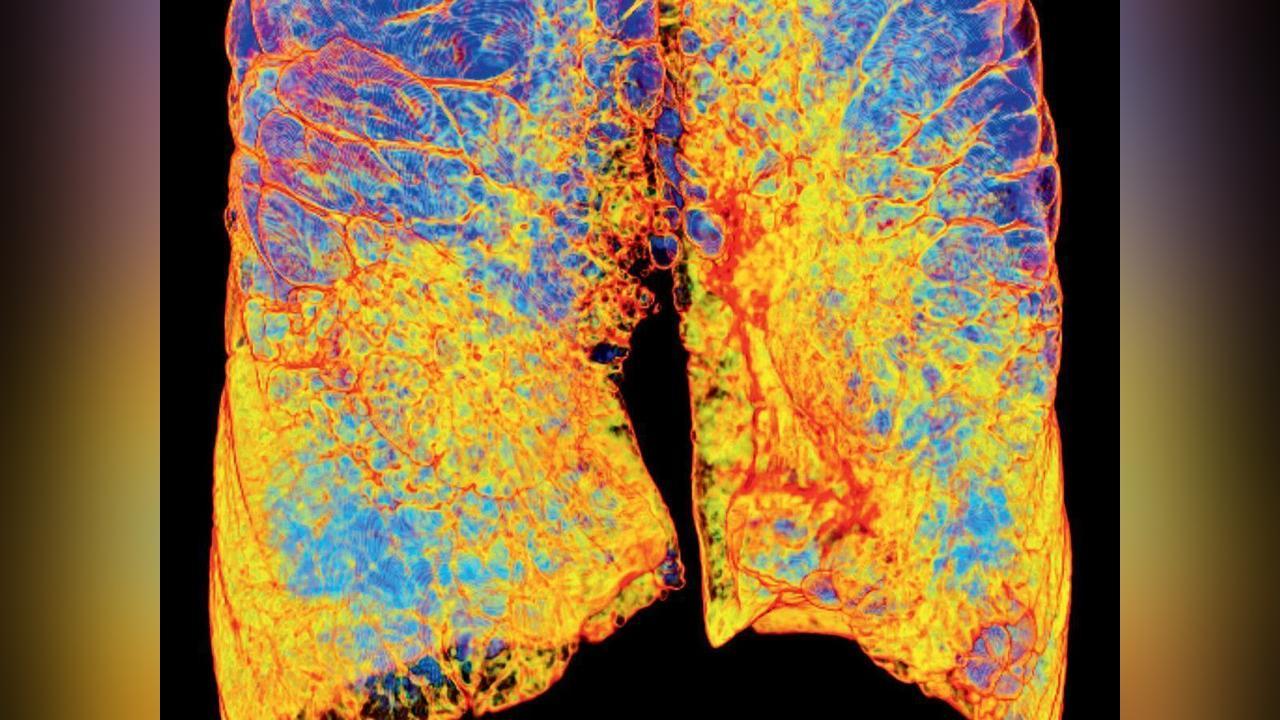 Poumons: BPCO, L’épidémie Silencieuse Poumons: BPCO, L’épidémie Silencieuse