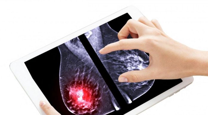 Quart des Femmes Diagnostiquées Ont Moins de 50 Ans Quart des Femmes Diagnostiquées Ont Moins de 50 Ans