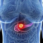 Cancer du Pancréas Éliminé chez la Souris Cancer du Pancréas Éliminé chez la Souris