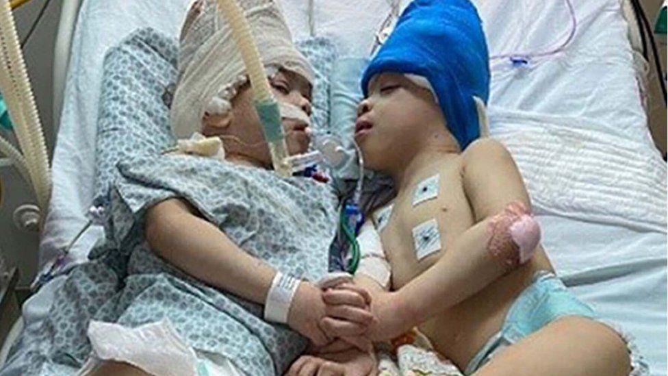 Conjoined twins separated with the help of virtual reality Conjoined twins separated with the help of virtual reality