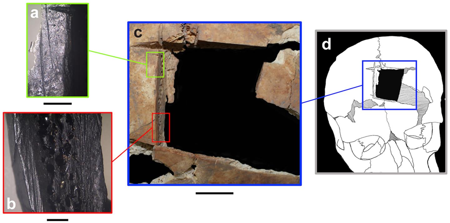 Archeologists Stunned After Discovering Possible Purpose of Square Hole in 3,500-Year-Old Skull Archeologists Stunned After Discovering Possible Purpose of Square Hole in 3,500-Year-Old Skull