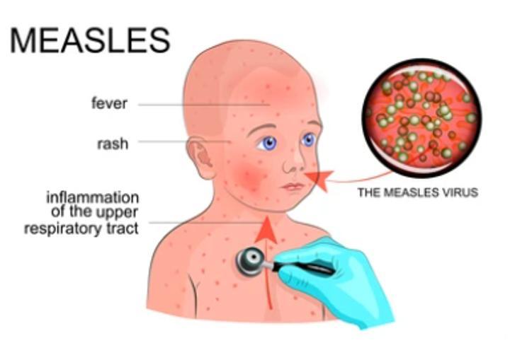 Measles vaccination campaign underway in Ayod Measles vaccination campaign underway in Ayod
