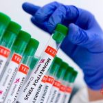 Western Equatoria records 19 Mpox cases since outbreak Western Equatoria records 19 Mpox cases since outbreak