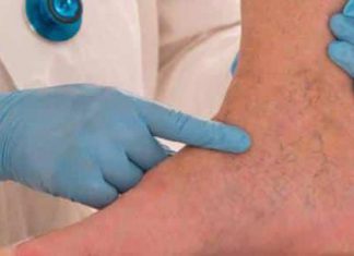 أعراض الجلطة الدموية في الساقين أعراض الجلطة الدموية في الساقين