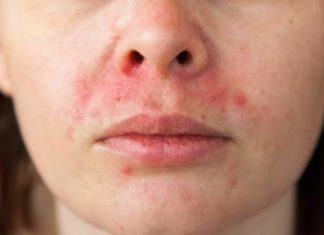 أعراض حساسية الهستامين أعراض حساسية الهستامين