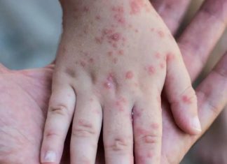 حالات الإصابة بـ “جدري القردة” في ارتفاع حالات الإصابة بـ "جدري القردة" في ارتفاع