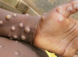 السلطات الصحية في السودان تترقّب نتائج عينات بشأن” جدري القرود” السلطات الصحية في السودان تترقّب نتائج عينات بشأن” جدري القرود”