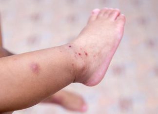 أسباب ظهور الدمامل وطرق علاجها أسباب ظهور الدمامل وطرق علاجها