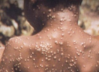 “مكافحة الأوبئة” تتقصى لمعرفة مصدر عدوى جدري القرود (مكافحة الأوبئة) تتقصى لمعرفة مصدر عدوى (جدري القرود)