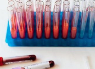 فحص سريع يكتشف مرضين بسرعة فائقة فحص سريع يكتشف مرضين بسرعة فائقة