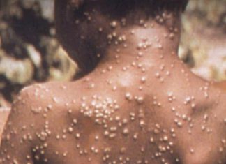 مصادر تكشف تطورات تفشي جدري القرود بمعسكرات اللاجئين في القضارف مصادر تكشف تطورات تفشي جدري القرود بمعسكرات اللاجئين في القضارف