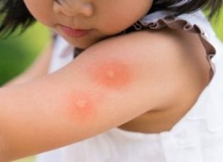 خطورة لدغات البعوض خطورة لدغات البعوض