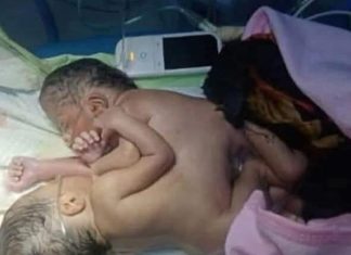 تفاصيل ولادة حالة توأم سيامي نادرة في مدينة ربك تفاصيل ولادة حالة توأم سيامي نادرة في مدينة ربك