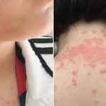 عائلة أميركية تقاضي طيران بسبب بقّ الفراش عائلة أميركية تقاضي طيران بسبب بقّ الفراش