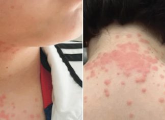 عائلة أميركية تقاضي طيران بسبب بقّ الفراش عائلة أميركية تقاضي طيران بسبب بقّ الفراش