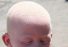 DON’T HIDE CHILDREN WITH ALBINISM – CALL