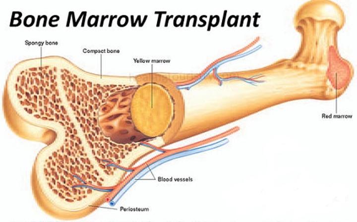 New milestone in bone marrow transplant New milestone in bone marrow transplant