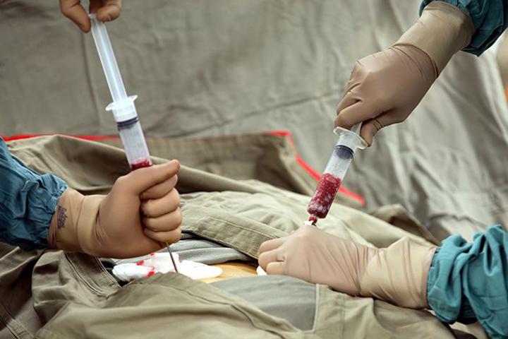 What Muhimbili success with bone marrow transplant means What Muhimbili success with bone marrow transplant means
