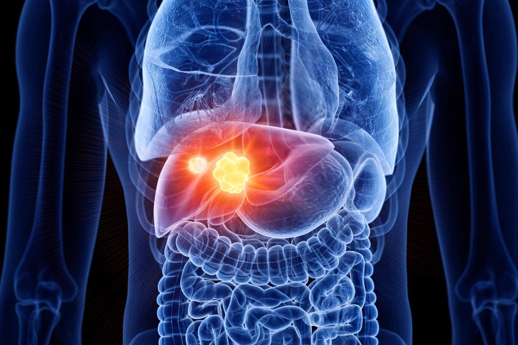 dar-rmo-calls-for-liver-cancer-studies-tanzania