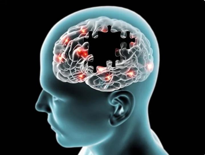 Maladie d’Alzheimer : son origine enfin découverte ? Maladie d’Alzheimer : son origine enfin découverte ?